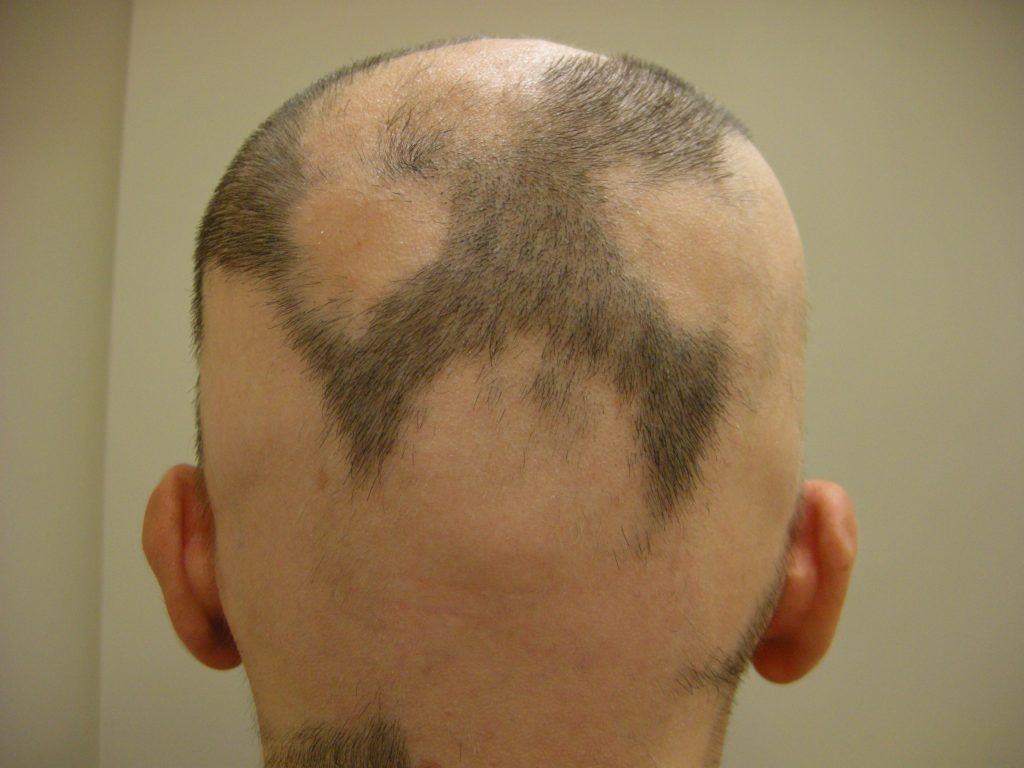 alopecia areata cura naturale